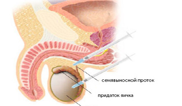 Фото: Биопсия яичка