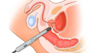 Фото: УЗИ предстательной железы