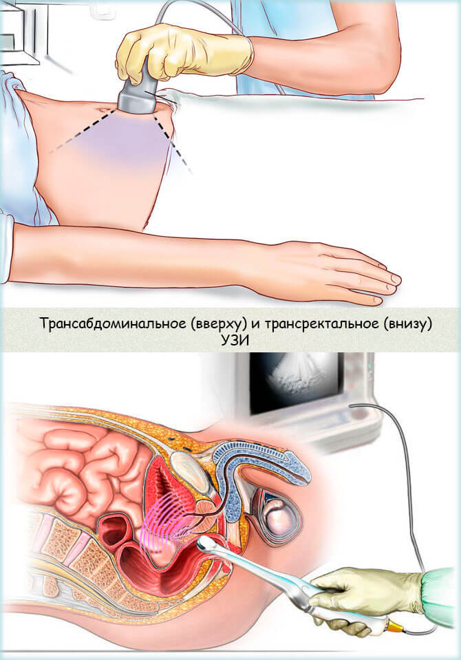 Фото: Как проводится УЗИ исследование предстательной железы?